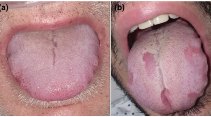 Photo of normal tongue (left) and coronavirus tongue
