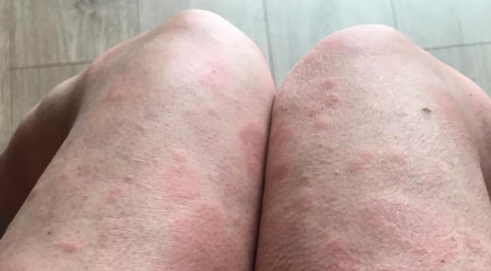 Allergic reaction to Covid vaccine