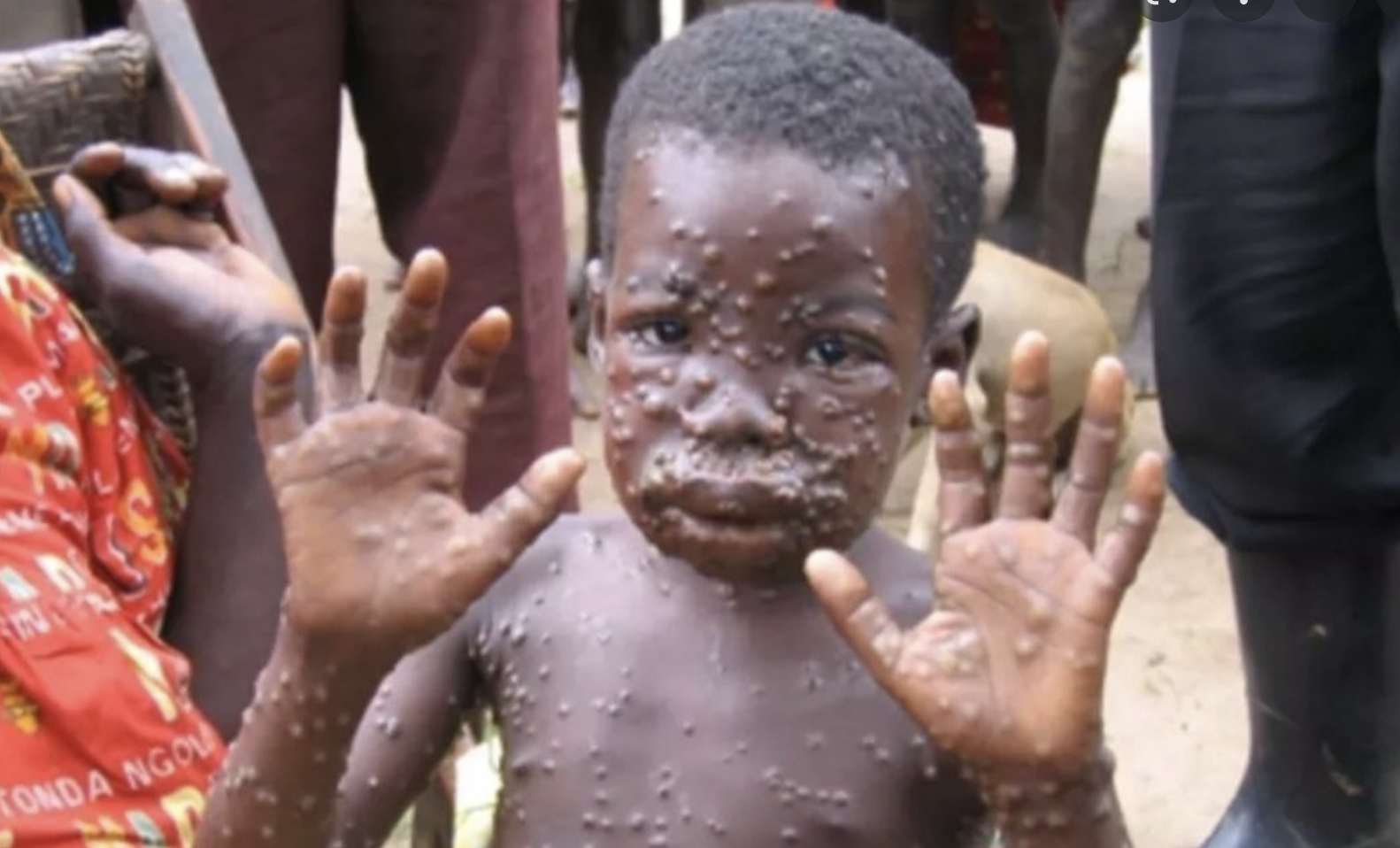 Young monkeypox victim