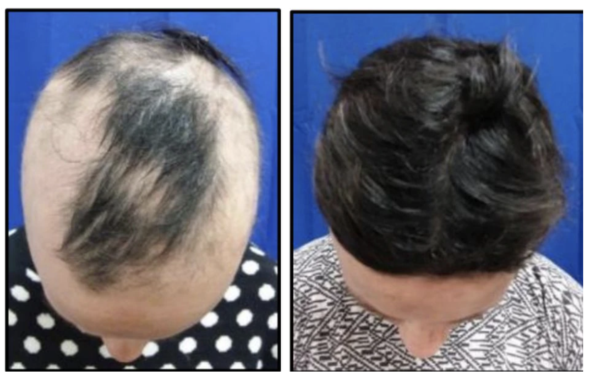 A volunteer with severe hair loss from alopecia areata grew a nearly full head of hair over 24 weeks in Concert's earlier Phase 2 clinical trial.CONCERT PHARMACEUTICALS