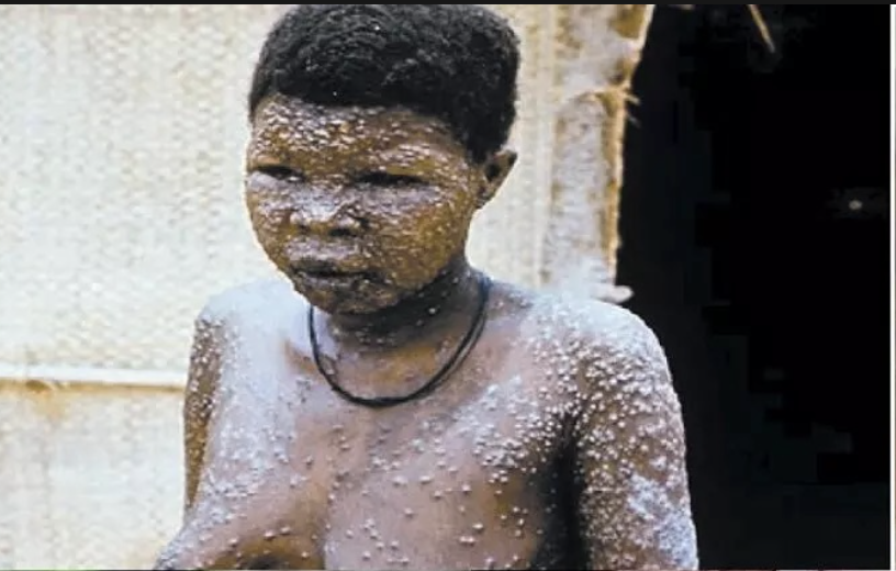 Person with monkeypox