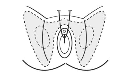 Illustration of vaginal mesh tape procedures commonly used for urinary incontinence: