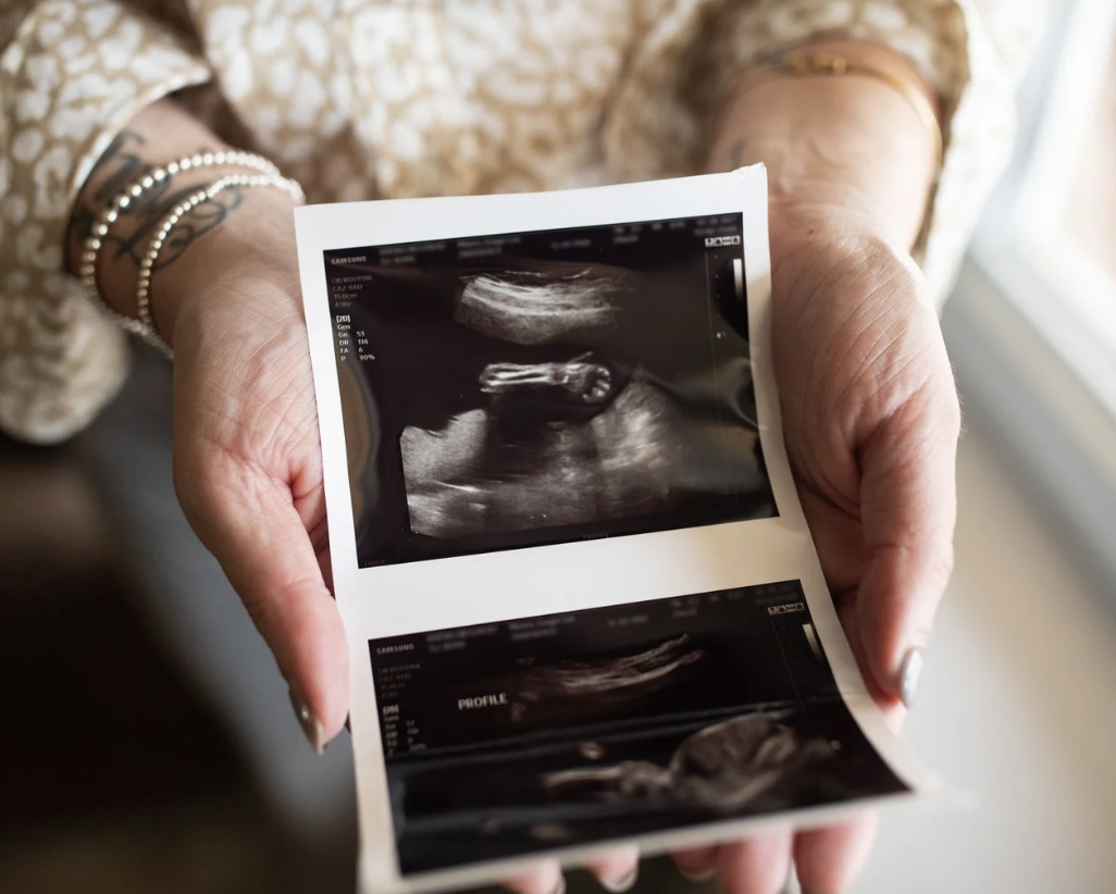 Ginger Munro holds the sonogram of her daughter Elliotte at her home in Ohio. Munro was hospitalized with COVID-19, placed on life support, and delivered her stillborn daughter at 27 weeks. Part of the image is blurred to conceal personal medical information. Credit: Maddie McGarvey for ProPublica