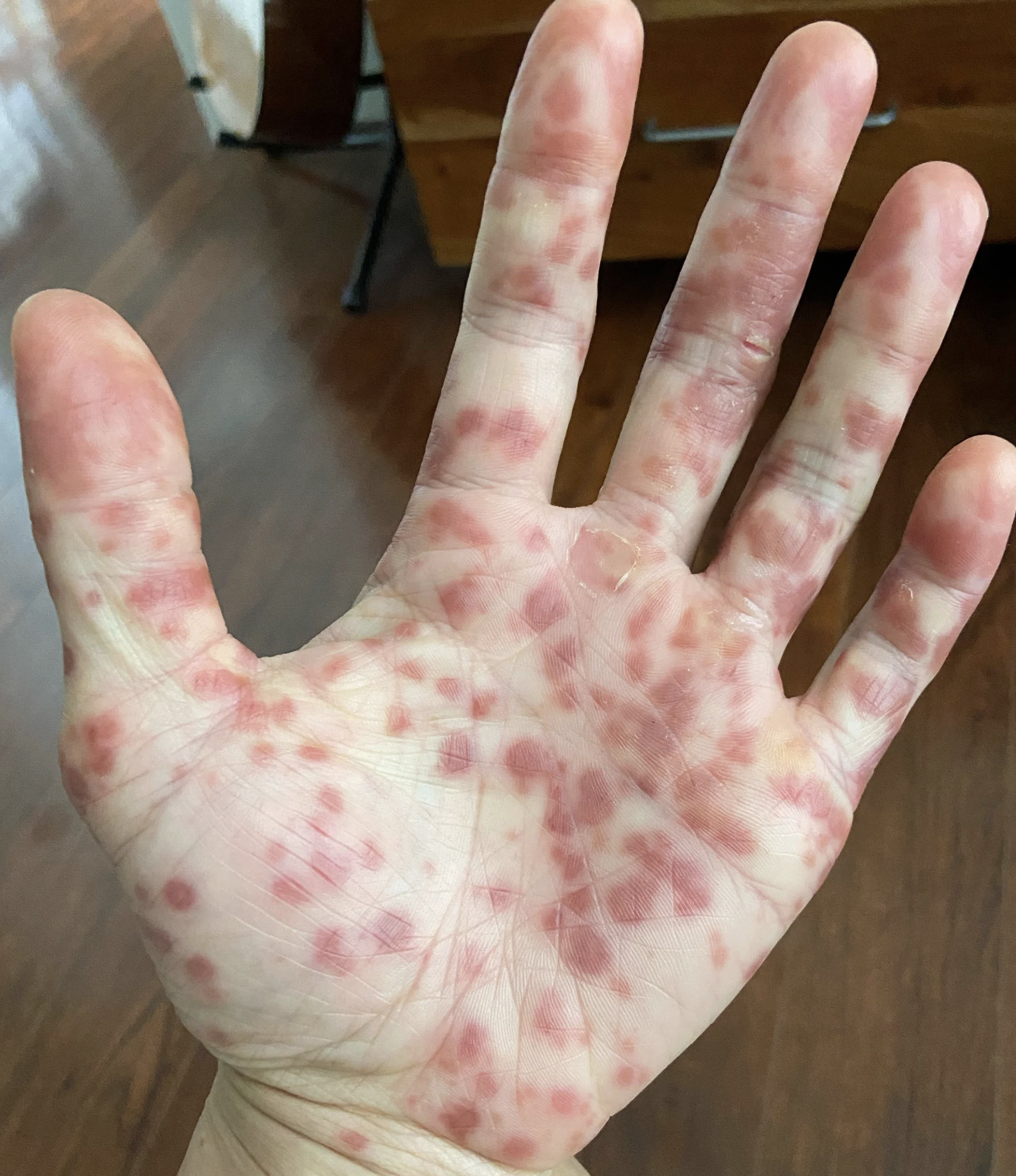 Rash on the hand of Kevin Kwong