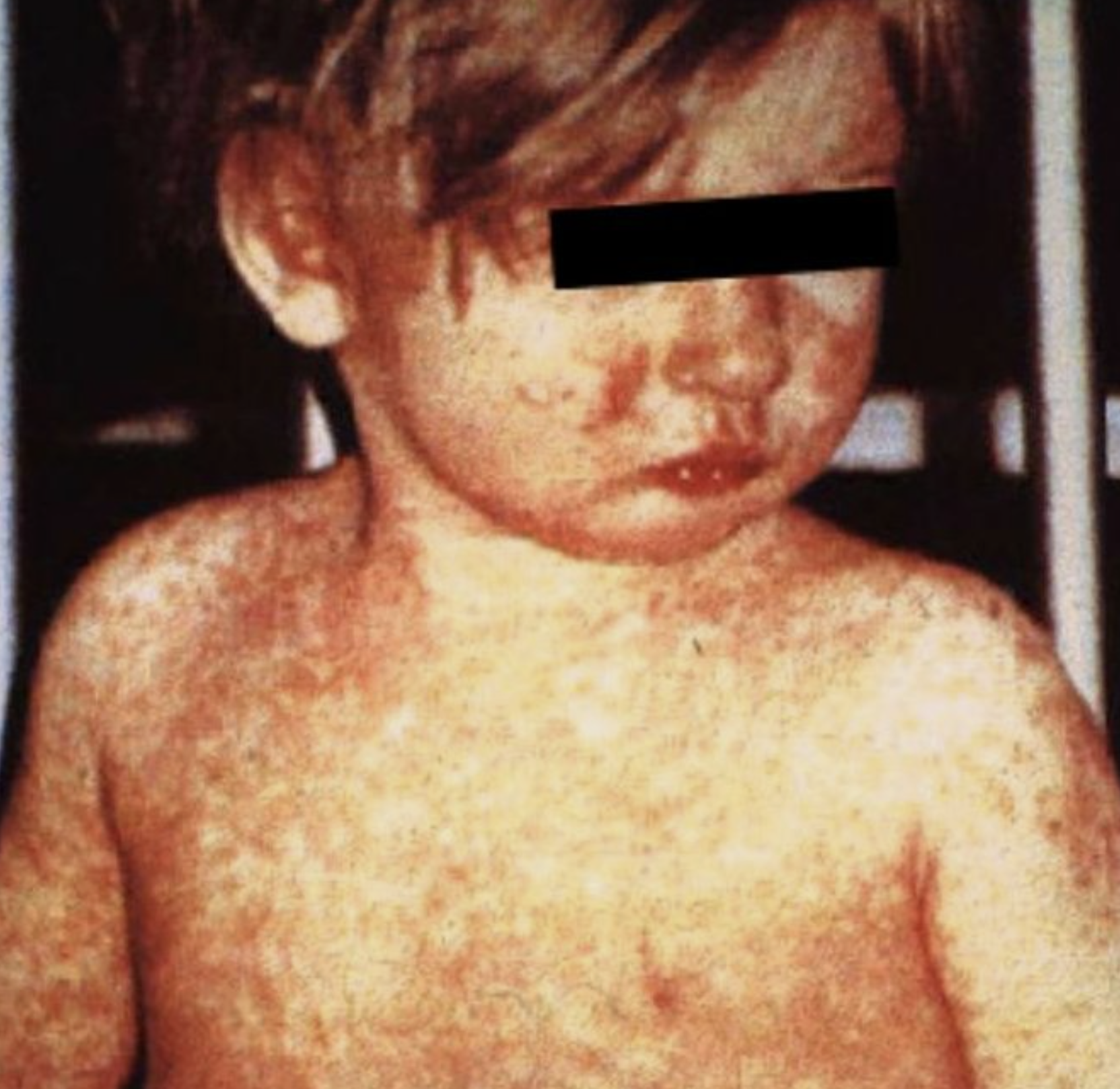 This child, who had been ill with measles, exhibited the characteristic rash on the fourth day of its evolution.
