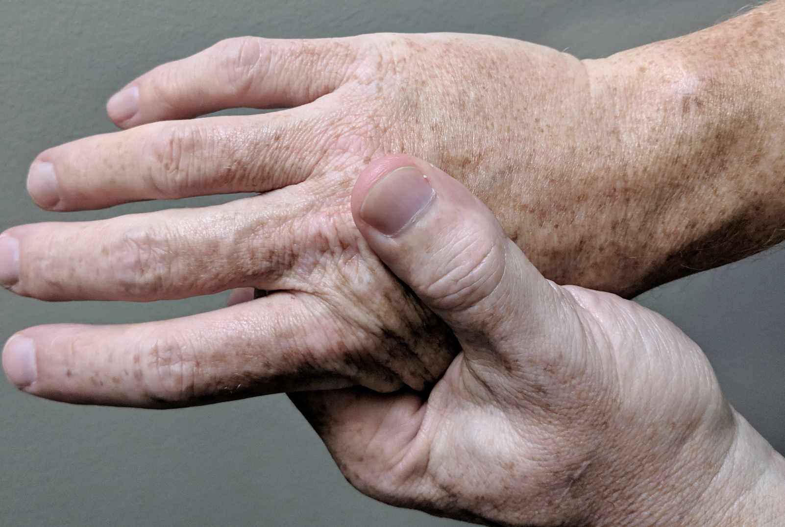 Arthritic hands in pain