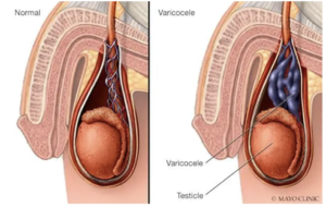 Medical illustration of varicoceles