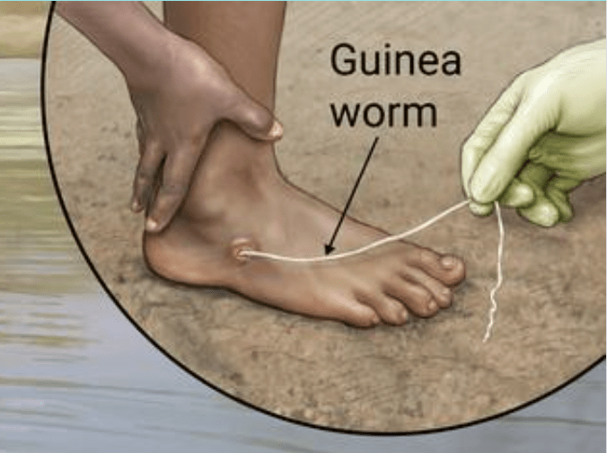 African Guinea worm illustration