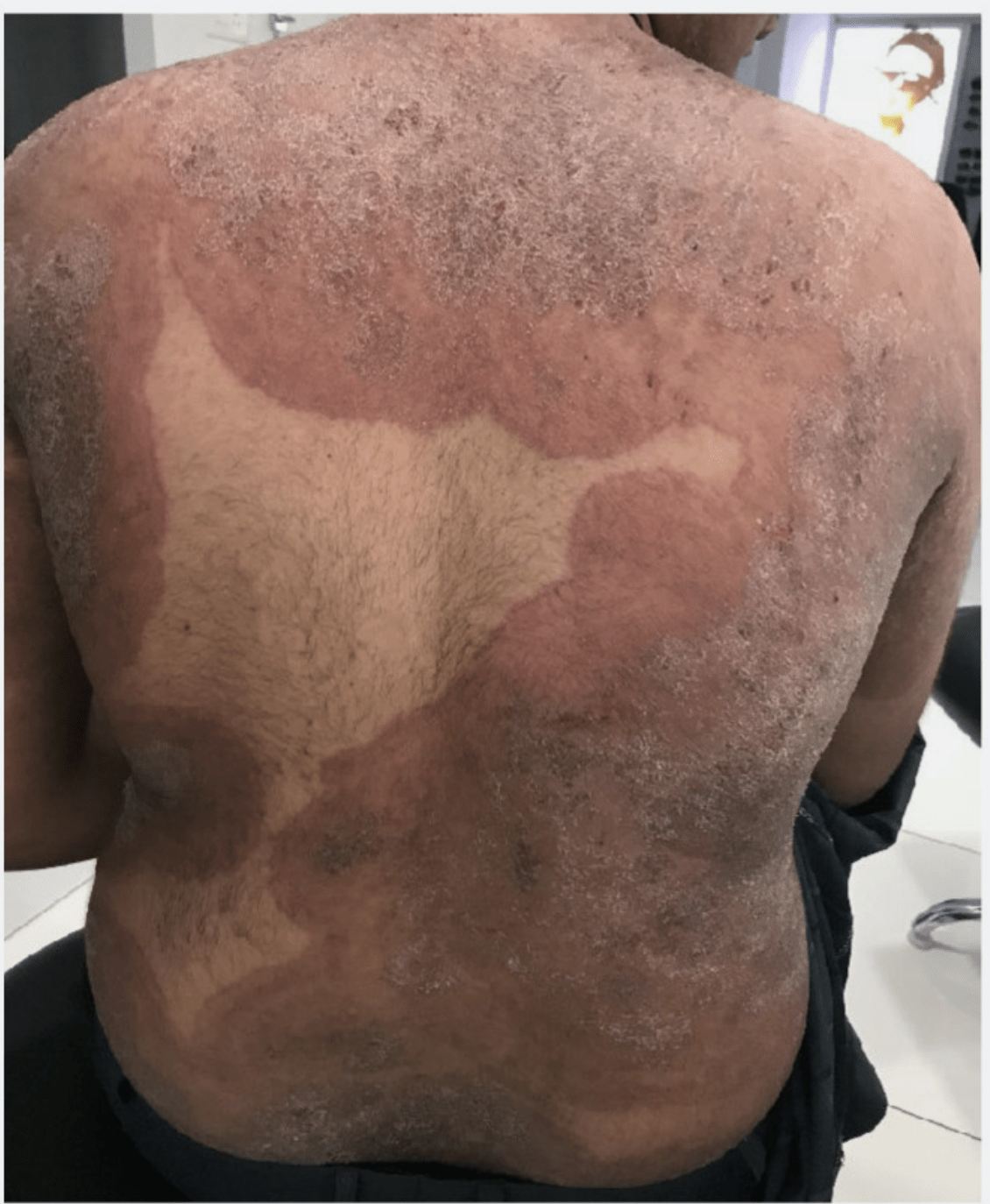 A Trichophyton indotineae infection on the back of an Indian man.