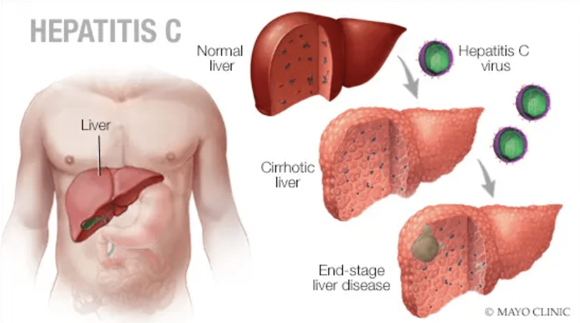 Mayo Clinic illustration, hepatitis C