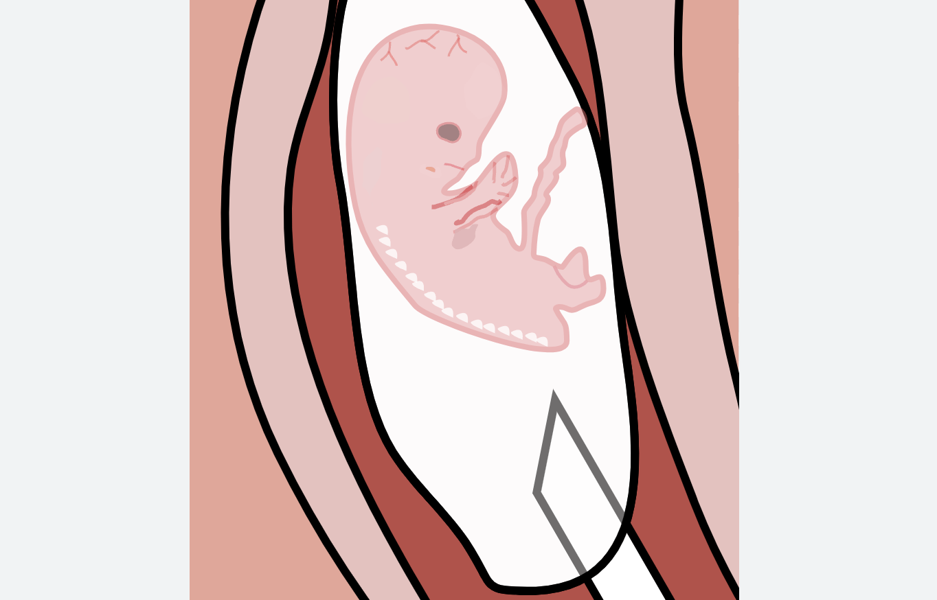 Illustration of a fetus about to be aborted