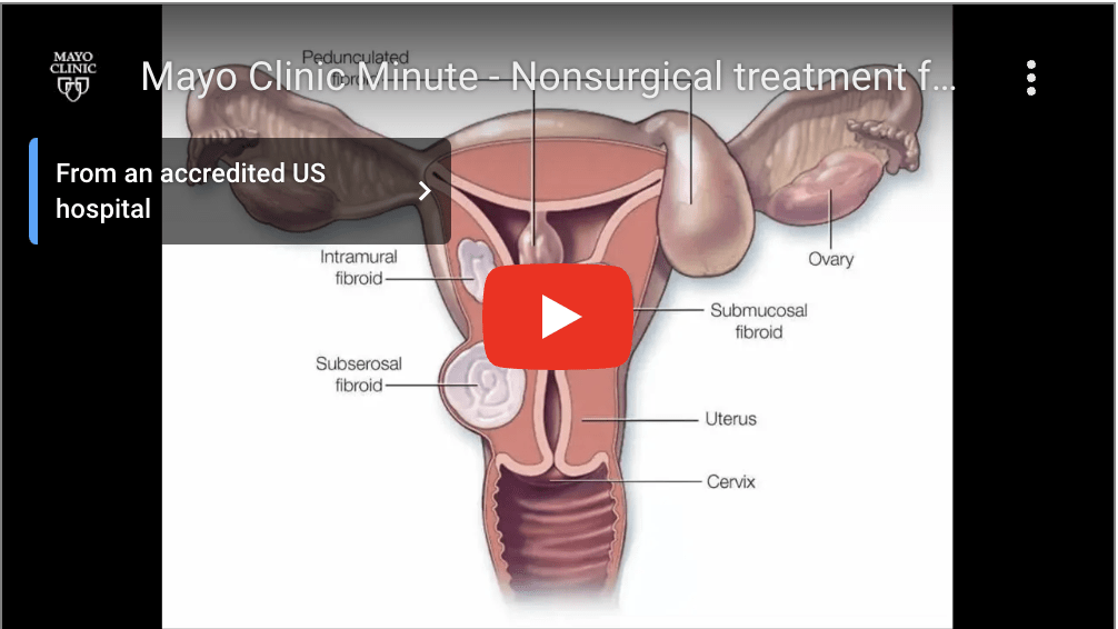 SCREENSHOT, Mayo Clinic video on fibroids