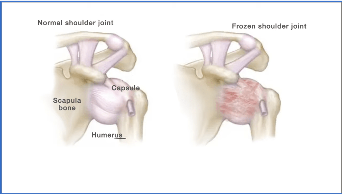 frozen shoulder illustration, Mayo Clinic