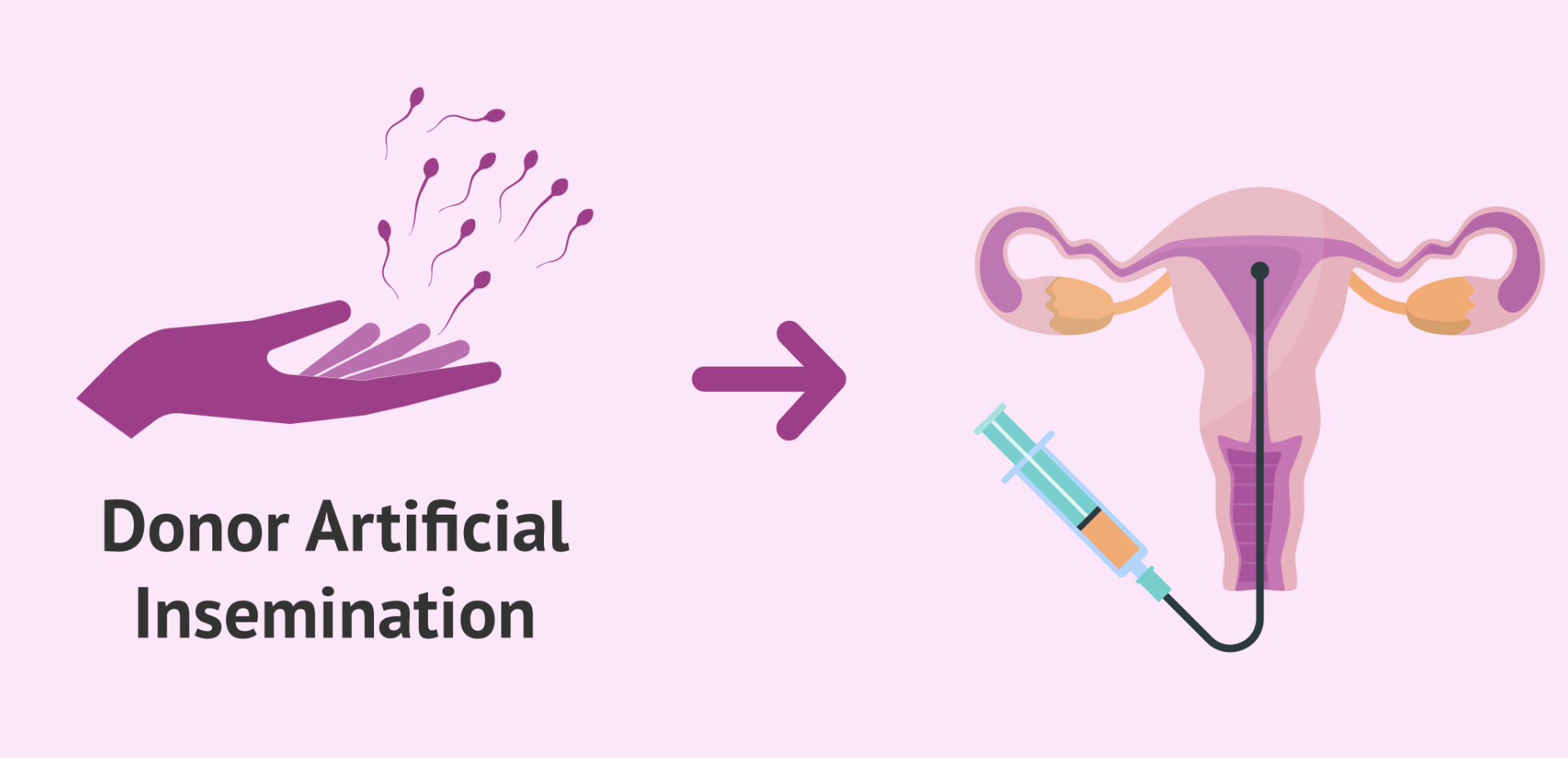 Donor intrauterine insemination illustration